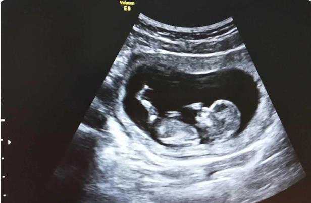 代孕可以做双胞胎吗_做代孕最好的医院_试管婴儿胚胎着床成功，如何判断是男